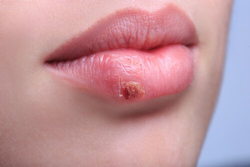 Cómo prevenir un brote de herpes labial
