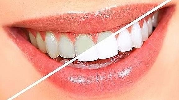 Clínica Dental Clidecem - Dentista de Confianza en Puente Genil - Color Dientes