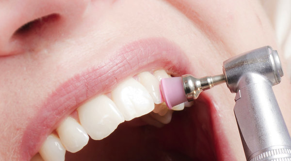 Clínica Dental Clidecem - Dentista de Confianza en Puente Genil - Limpieza Dental