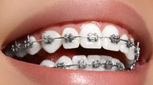 Clínica Dental Clidecem - Dentista de Confianza en Puente Genil - Ortodoncia