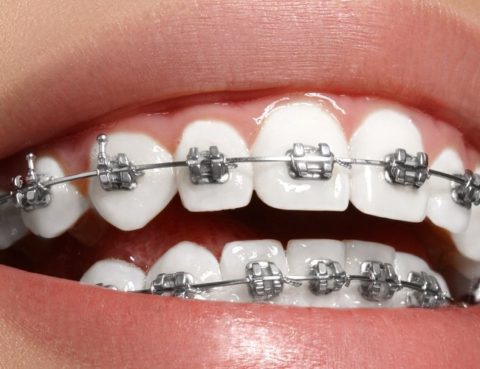 Clínica Dental Clidecem - Dentista de Confianza en Puente Genil - Ortodoncia