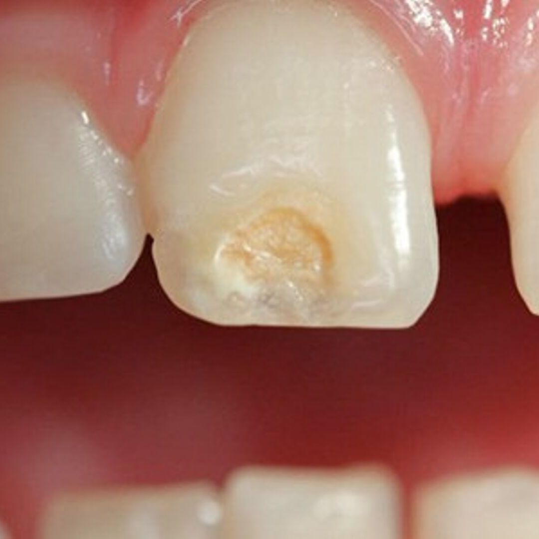 Manchas en los dientes: Tipos y tratamientos.