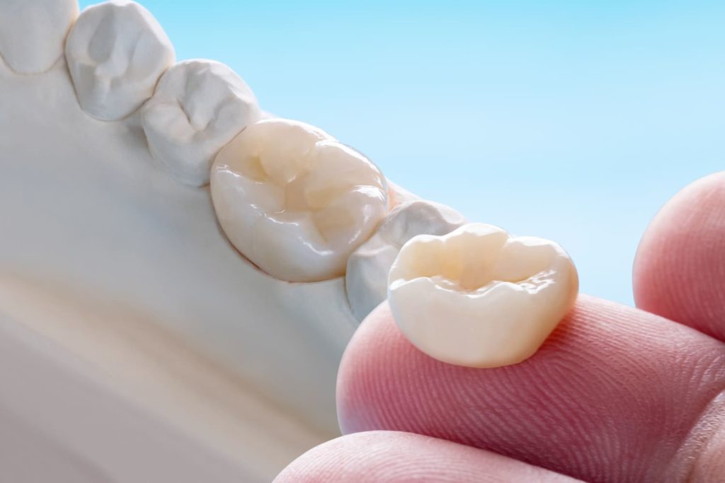 Cuánto dura una corona dental?